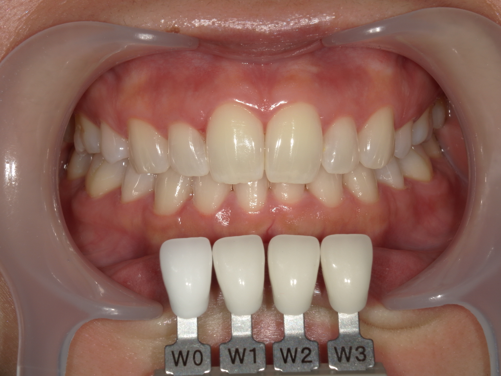 札幌市　ホワイトニング