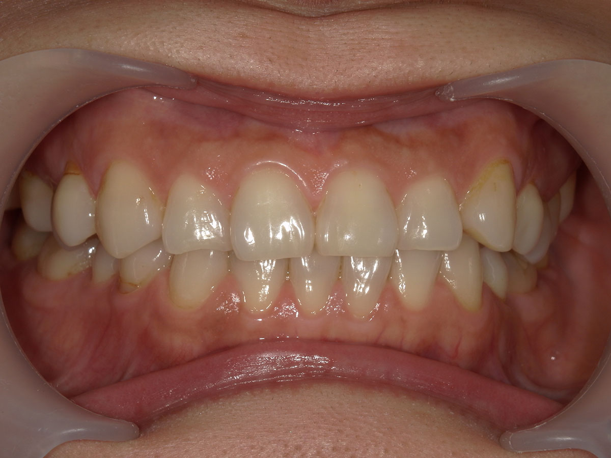 札幌　歯医者　矯正歯科　歯並びが悪い