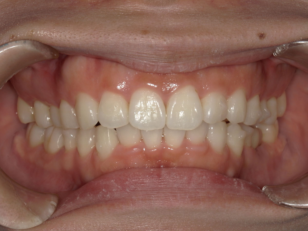 札幌　歯医者　矯正歯科　歯並びが悪い