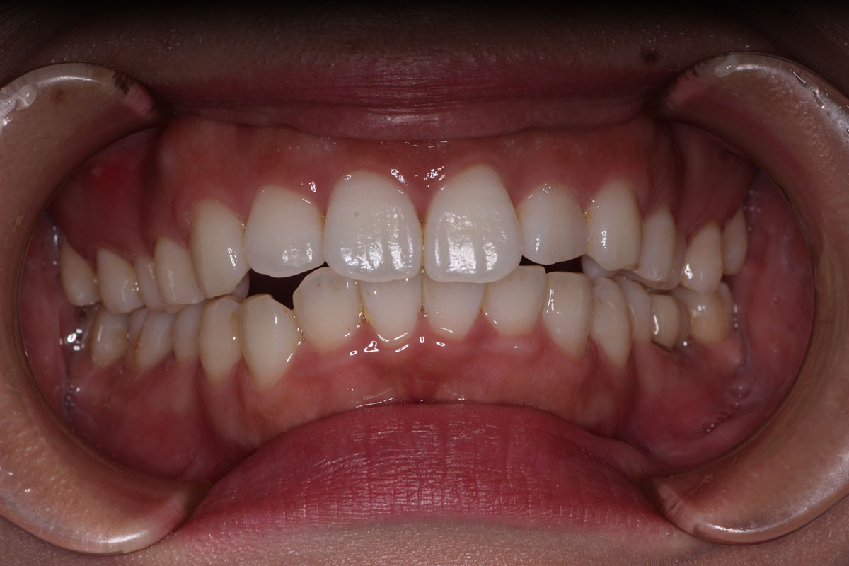 札幌　歯医者　矯正歯科　歯並びが悪い