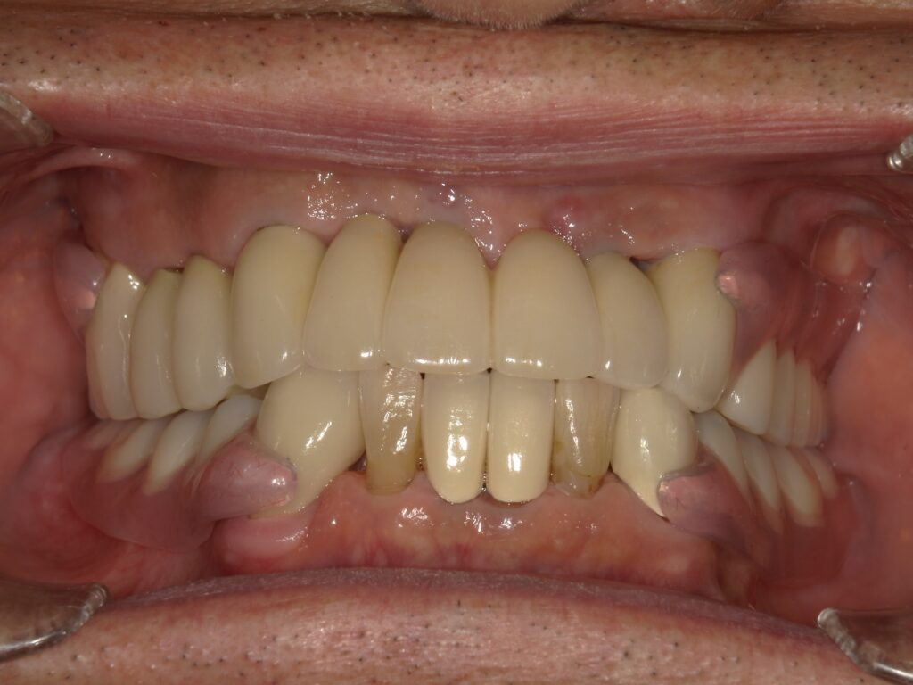 ミラクルデンチャーを使用して満足していただいた患者の写真