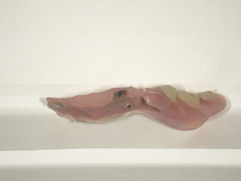 ミラクルデンチャーを使用して満足していただいた患者の写真