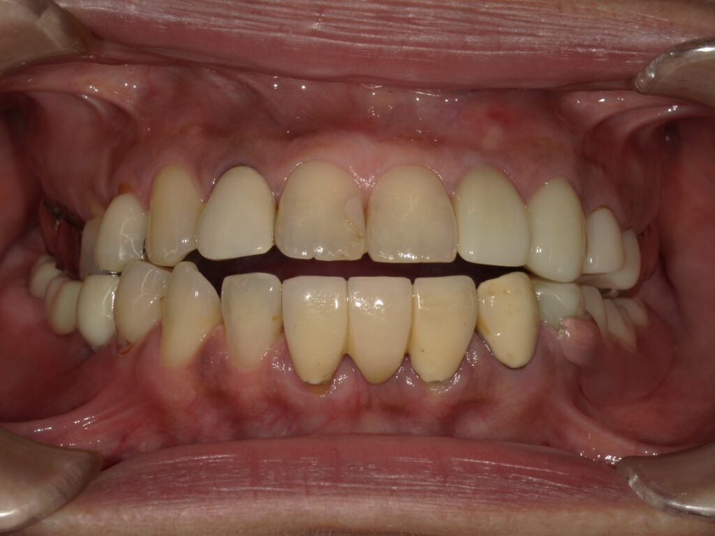 ミラクルデンチャーを使用して満足していただいた患者の写真