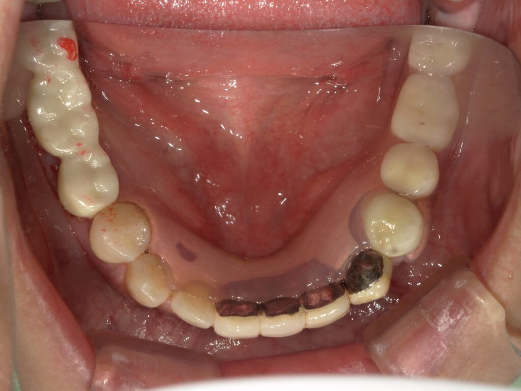 ミラクルデンチャーを使用して満足していただいた患者の写真