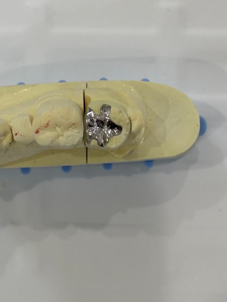 金属系の被せ物