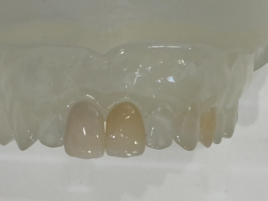 セラミック系の被せ物