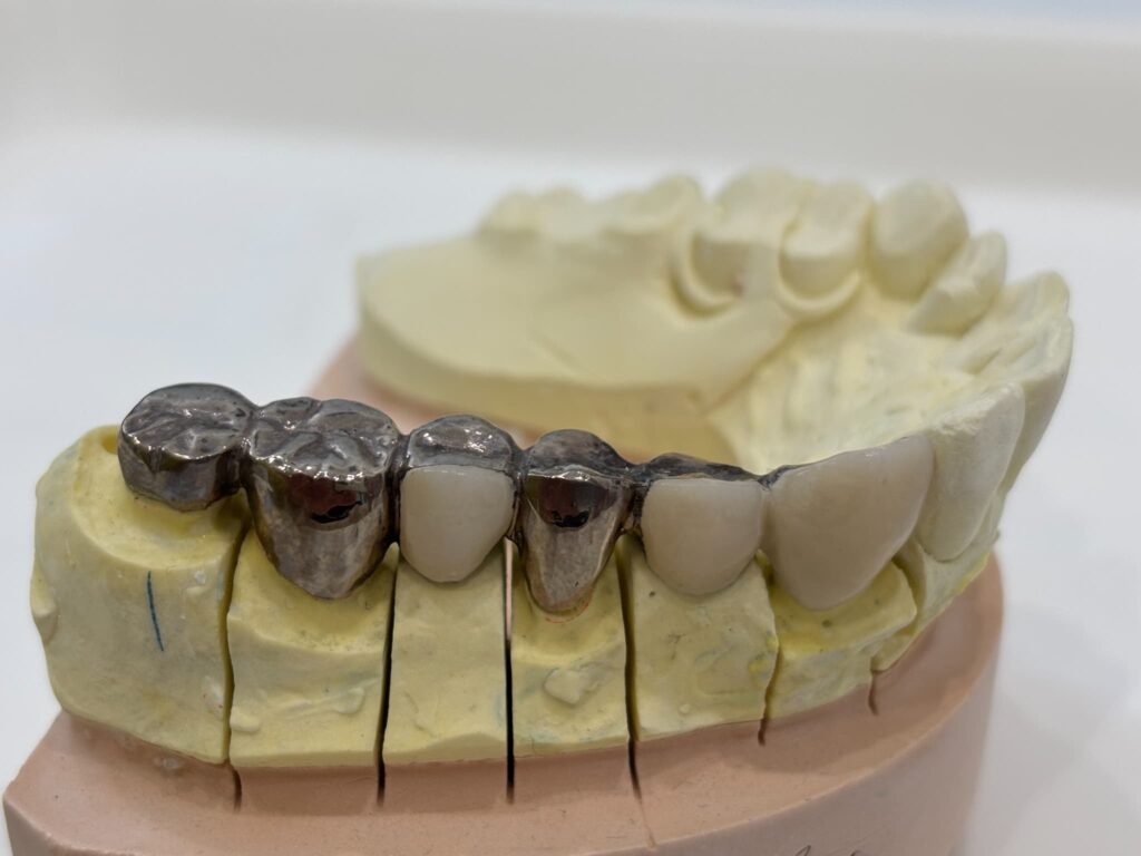 金属系の被せ物