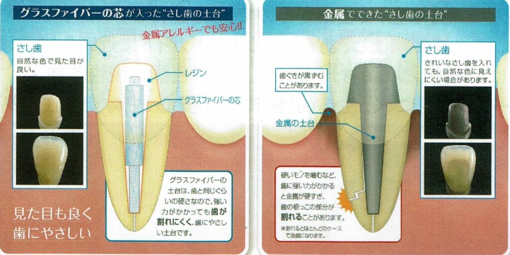 グラスファイバーと金属の芯の比較